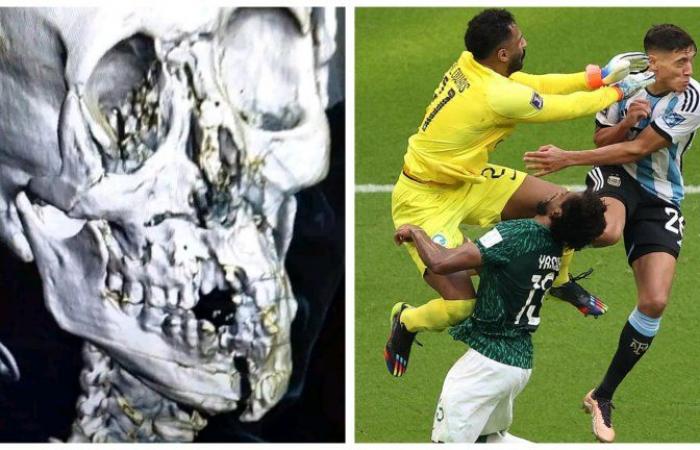 Broken jaw, broken bones, internal bleeding – the most brutal injury of the 2022 World Cup